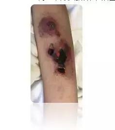 输液时肌腱损伤怎么办,输液造成组织坏死