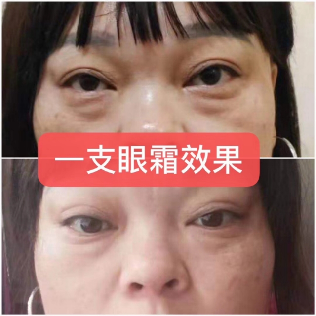 眼袋救星来了,医生推荐眼袋救星