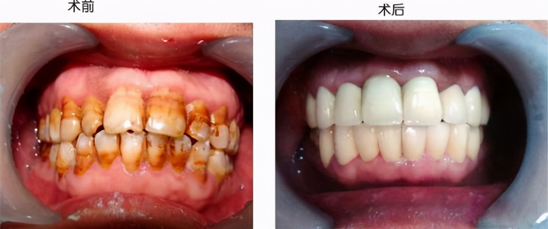 牙齿黄怎么办三招教你黄牙变白牙,黄牙黑牙真的能洗白吗