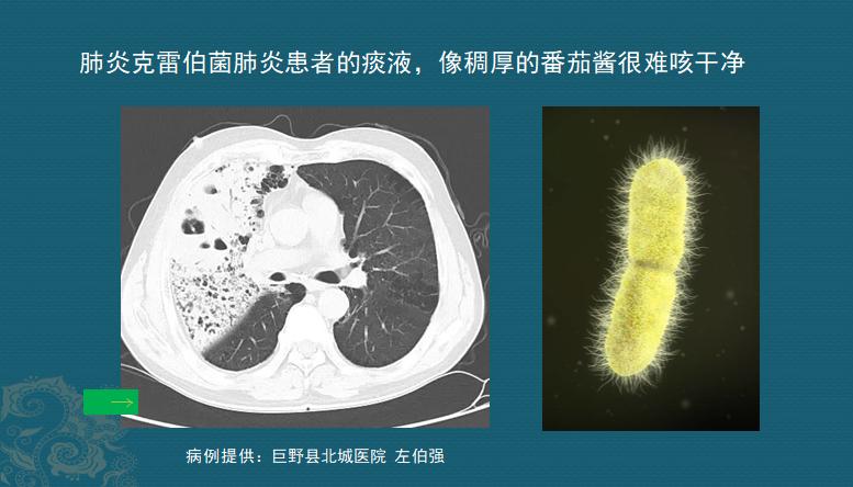 肺炎感染者吐痰,肺炎患者咳大量黄痰最有可能感染