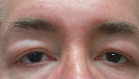 50多岁水肿是什么原因引起的,突然发胖水肿厉害什么原因