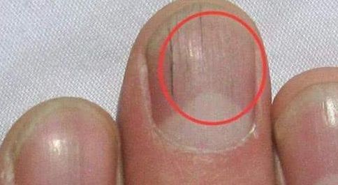 指甲表面长了竖纹，很多人恐慌自己身体不好？看完终于放心了