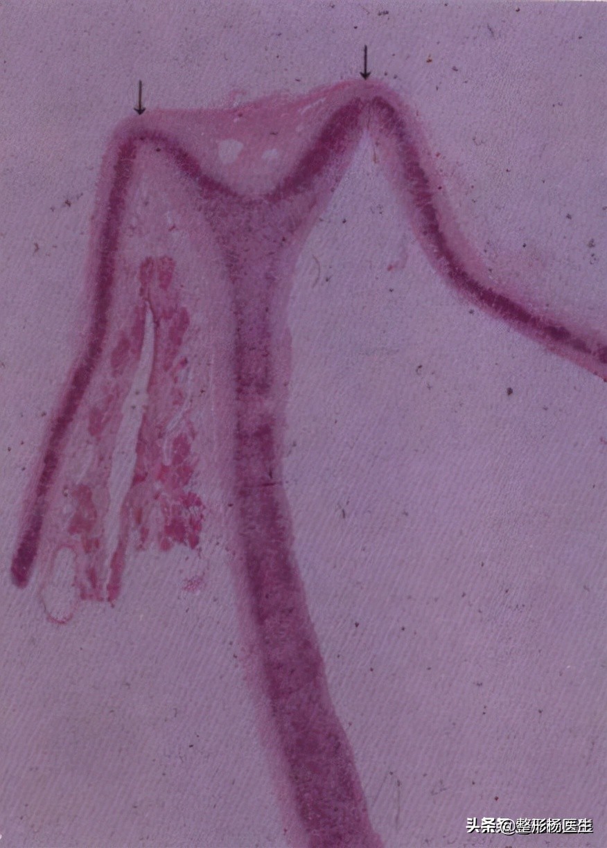 捏鼻梁神器变高真的吗,徒手捏鼻梁是真的吗