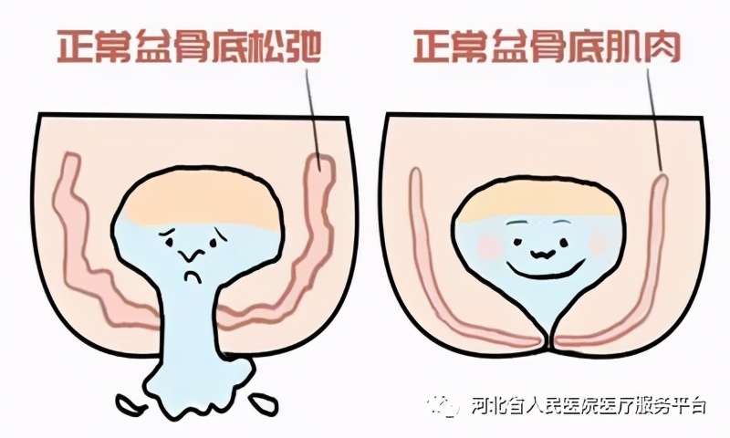 女性“漏尿”问题很难堪听妇科专家答疑解惑