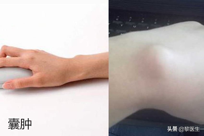 全身有结节囊肿息肉能治愈吗,宫颈囊肿息肉会癌变吗