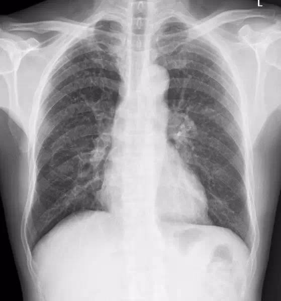 肺纹理增多与肺纹理重的区别,为什么正常胸片显示下肺纹理多