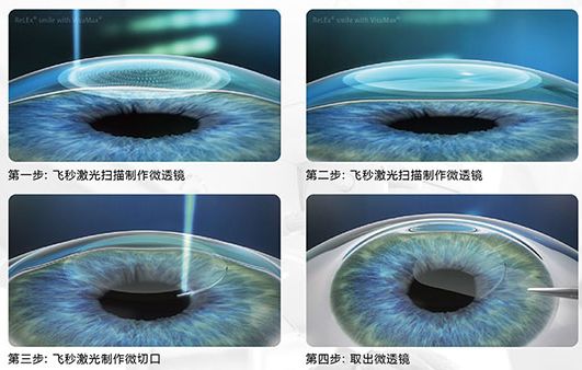 800度近视也能矫正吗,15岁近视800度增长得很快怎么办