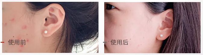 用香皂洗脸去油祛痘,硫磺香皂洗脸可以祛痘去油吗