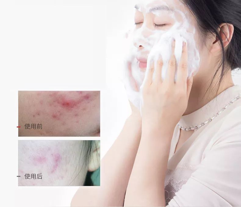 用香皂洗脸去油祛痘,硫磺香皂洗脸可以祛痘去油吗