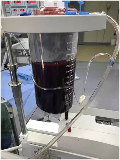 女子腹痛大便出血,女生突发腹泻严重脱水