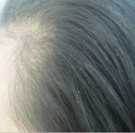 12岁女孩“头皮屑”多到吓人！竟是家人一个习惯造成的！