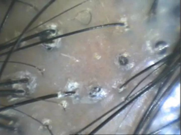 12岁女孩“头皮屑”多到吓人！竟是家人一个习惯造成的！