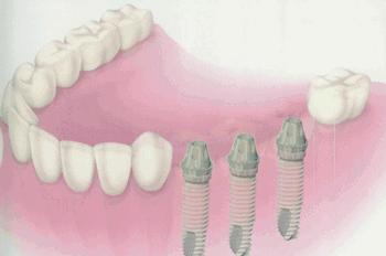 最新发布！12-80岁市民快看，种植牙、矫正牙齿10项全减免~