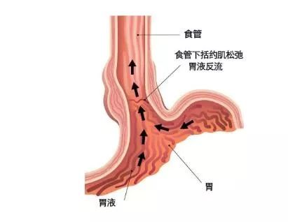 「名医」你按照胃病来治疗却效果不佳？其实是胃食管反流！