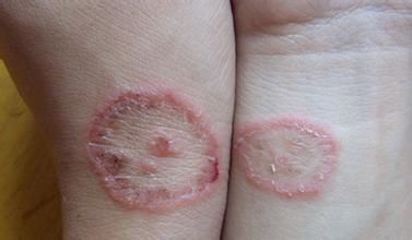 奇怪！杭州两女孩合租一间房得了一样的病！胳膊上都长了像钱币一样的疹子……