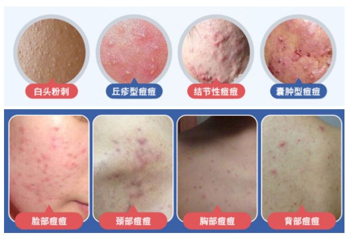 红肿,流脓的万年毒痘一喷全消失?岛国新晋痘肌终结者!彻底祛痘不反复!