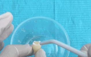 进行防龋齿牙齿窝沟封闭工作,窝沟封闭是保护牙齿最有效的方式