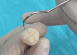 进行防龋齿牙齿窝沟封闭工作,窝沟封闭是保护牙齿最有效的方式