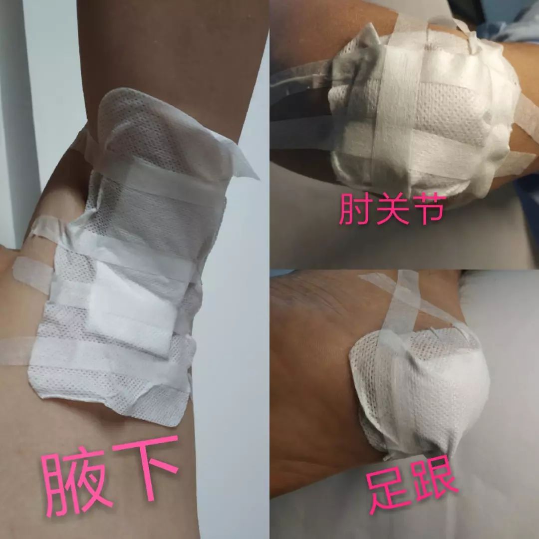 特殊敷料敷贴,手术缝合口粘贴敷料使用方法