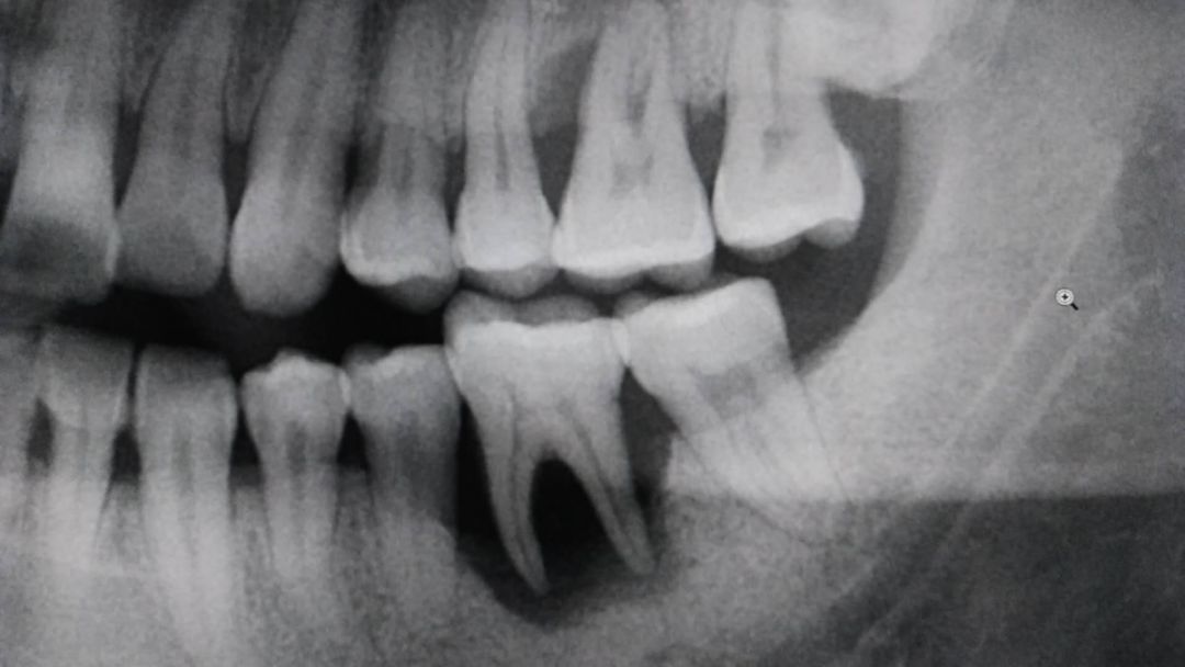 不会用牙签剔牙,你真的以为用牙签剔牙正确吗