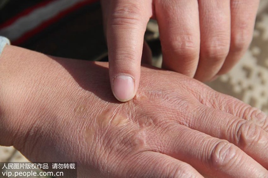 网红祛疤产品真的有效吗,增生去疤膏网红