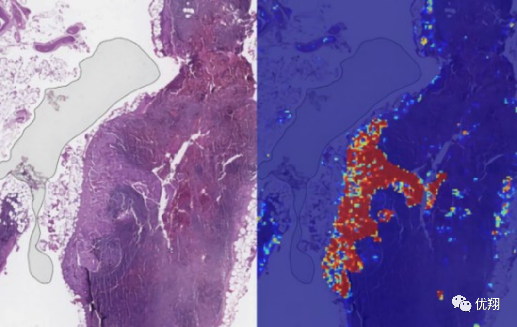 谷歌AI医疗放大招：将转移性乳腺癌检测准确率推向99%！