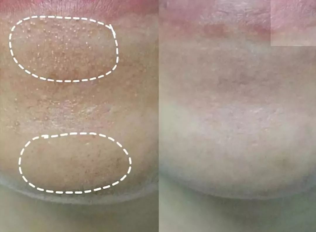 还在用洗面奶洗脸卸妆就out了！用它轻轻一刷，几秒就能深层清洁每个毛孔，感觉黑头都蹦出来了！