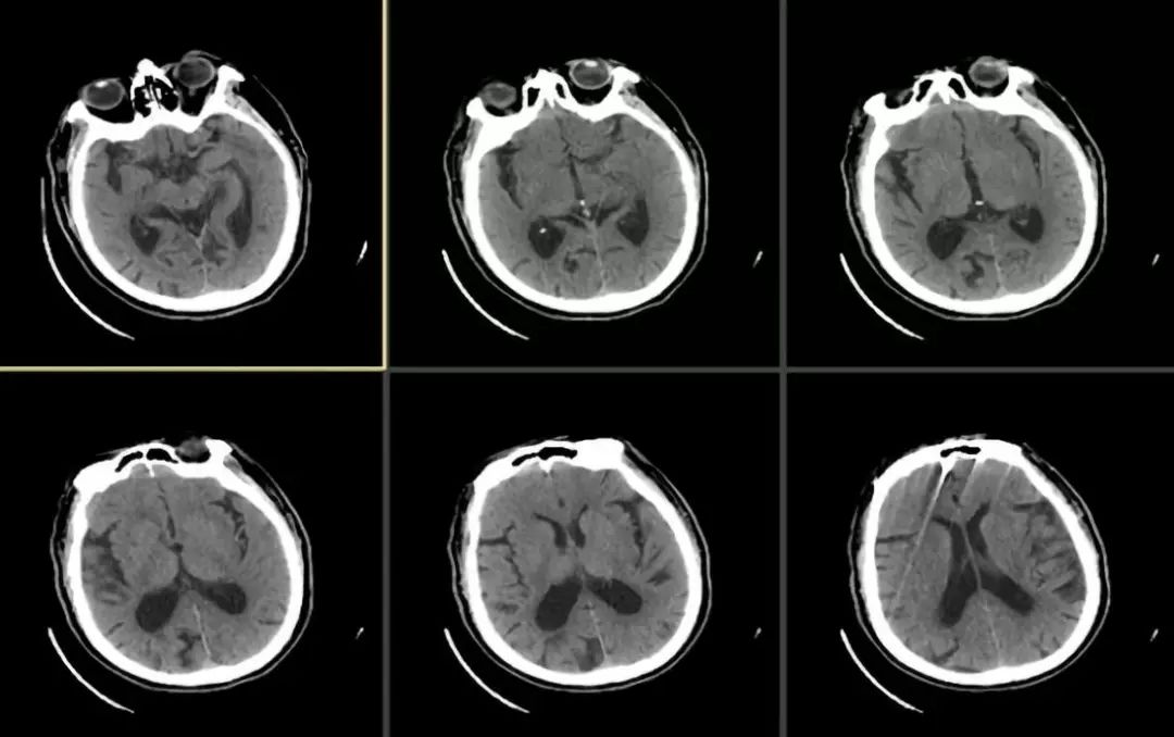颈动脉狭窄介入治疗的后遗症,颈动脉闭塞介入手术是局麻吗