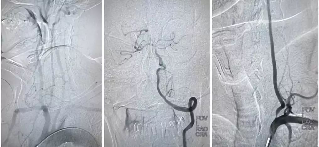 颈动脉狭窄介入治疗的后遗症,颈动脉闭塞介入手术是局麻吗