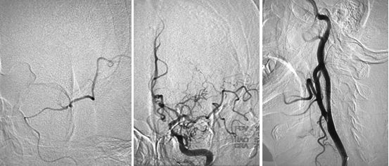 颈动脉狭窄介入治疗的后遗症,颈动脉闭塞介入手术是局麻吗