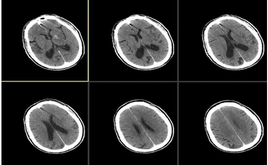 颈动脉狭窄介入治疗的后遗症,颈动脉闭塞介入手术是局麻吗