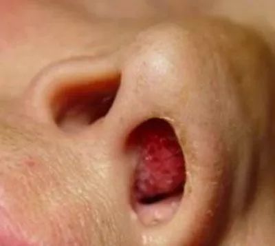 息肉切了定期复查会得癌吗,息肉癌变的前兆就是癌吗