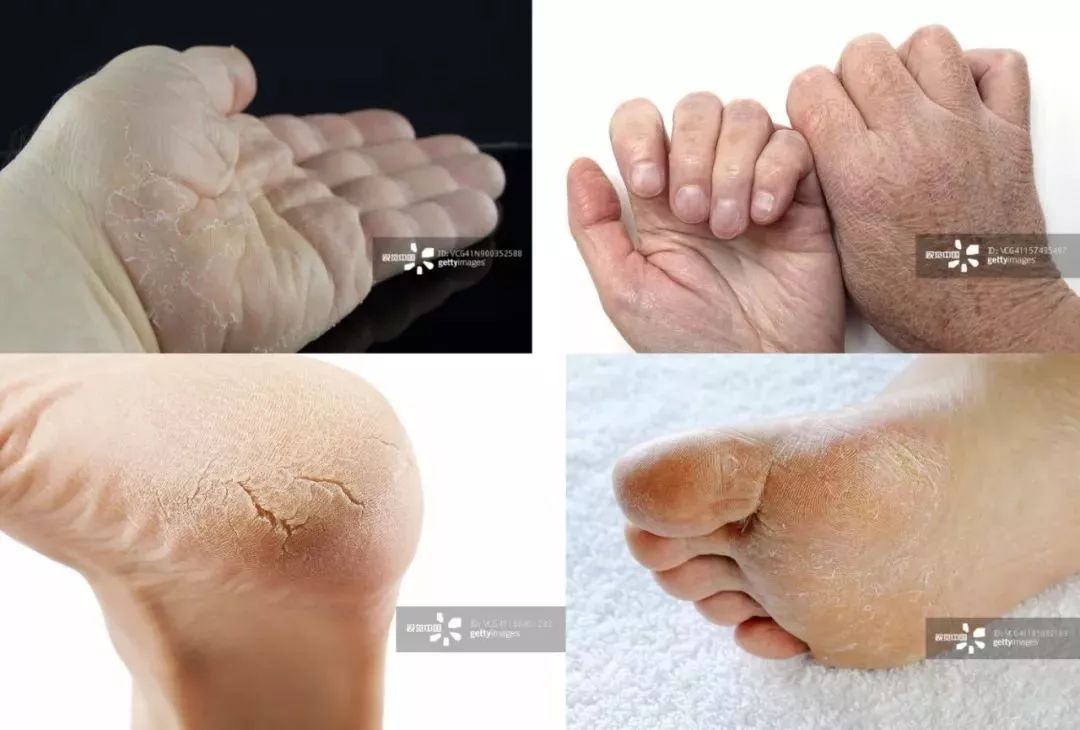 手脚冻疮怎么治断根,冬季治手脚干裂冻疮有效的药