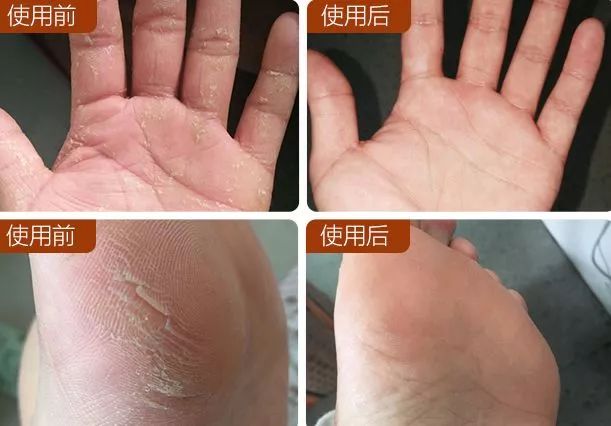 手脚冻疮怎么治断根,冬季治手脚干裂冻疮有效的药