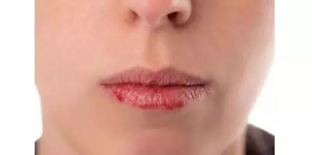 嘴唇干裂起皮怎么护理呀,涂口红嘴唇干裂脱皮是唇炎吗