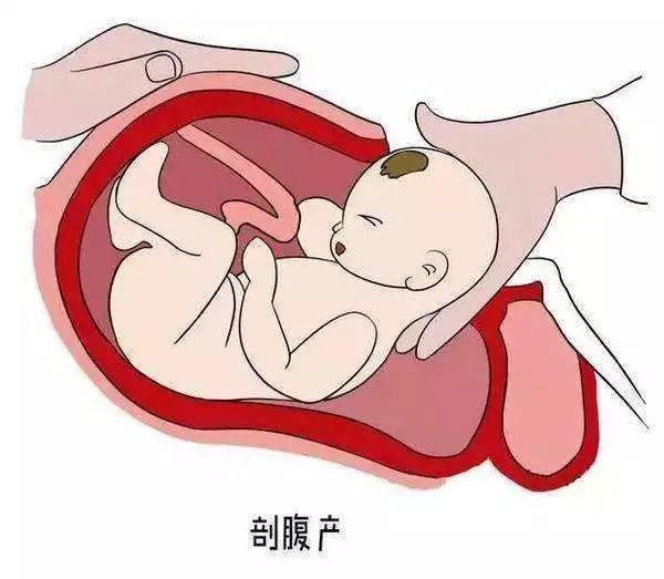 涨姿势｜顺产or剖宫产？哪种分娩好？是时候给你扫扫盲了