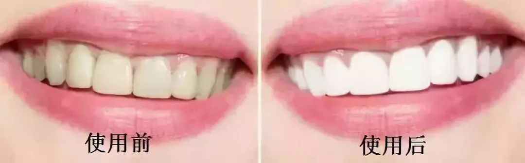 牙黄口臭用什么牙膏有效果一点,烟黄牙洗牙能洗白吗