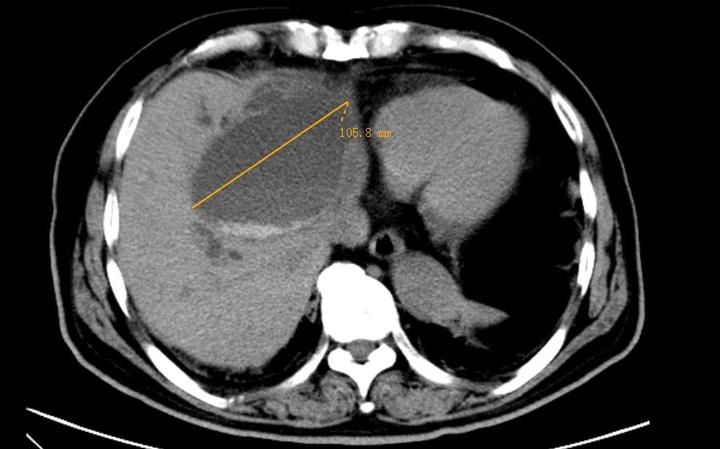 88岁老人胆管扩张30多倍！医生从中取出大大小小数百颗结石