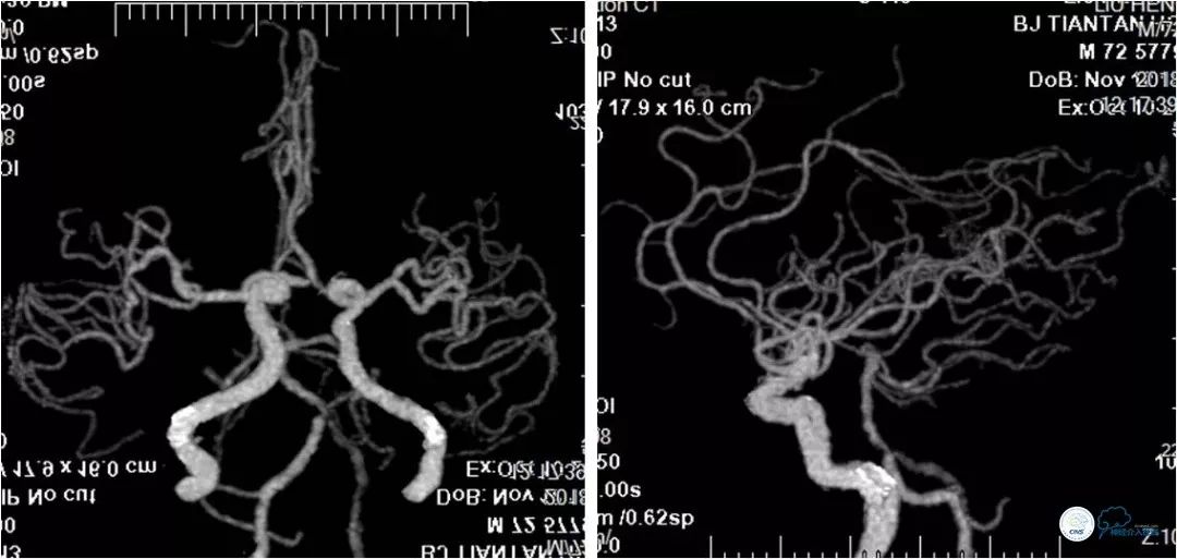 椎动脉狭窄介入手术病例汇报,基底动脉狭窄70%的介入治疗