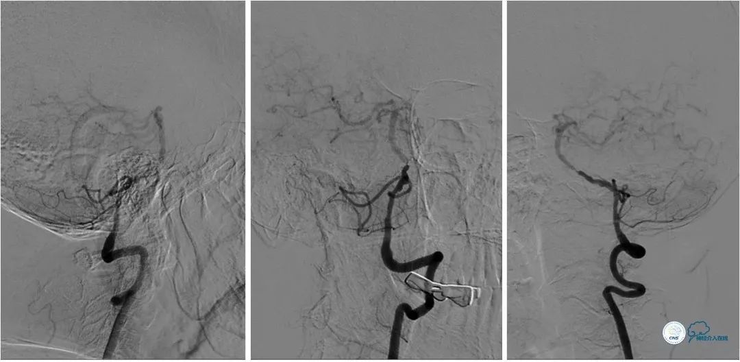 椎动脉狭窄介入手术病例汇报,基底动脉狭窄70%的介入治疗