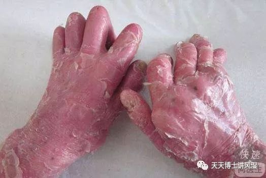 银屑病关节炎psa,关节炎型银屑病新药