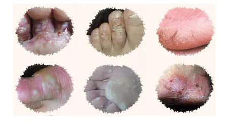 脚气脚臭难去除教你一招可以试试,脚臭脚气脚痒脱皮干裂一招根除