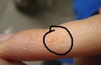 脚气脚臭难去除教你一招可以试试,脚臭脚气脚痒脱皮干裂一招根除