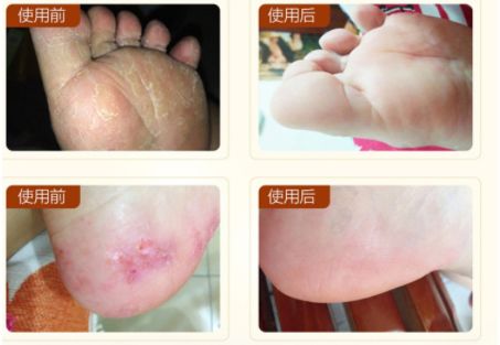 脚气脚臭难去除教你一招可以试试,脚臭脚气脚痒脱皮干裂一招根除