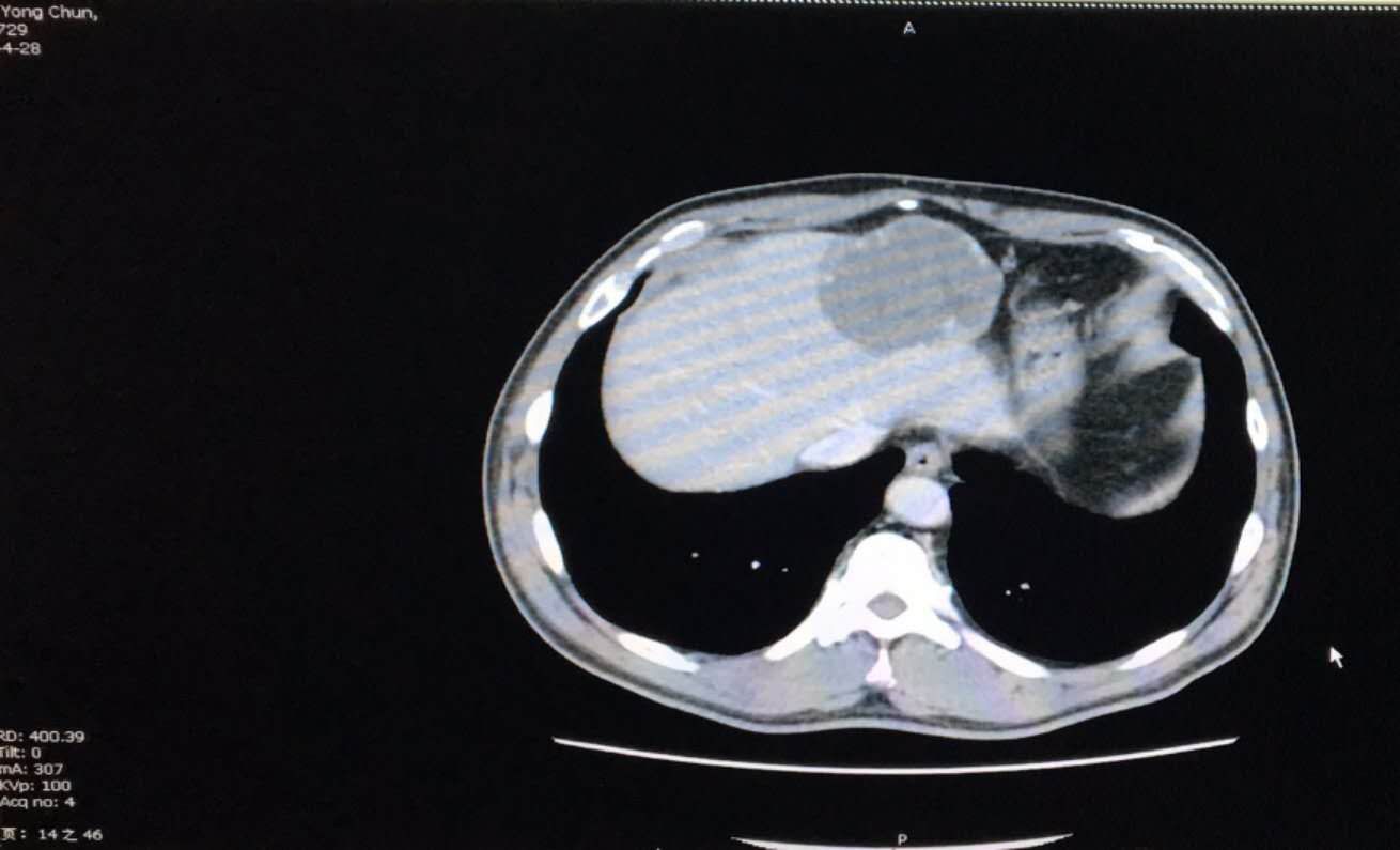 哈尔滨首例血管瘤,哈尔滨血管瘤去哪个医院