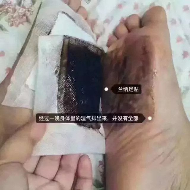 湿气不重但是很胖,泰国的祛湿足贴