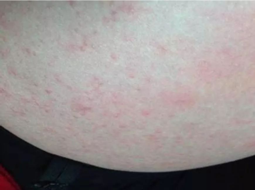 驱寒痛经艾灸,喝很多热水能不痛经吗