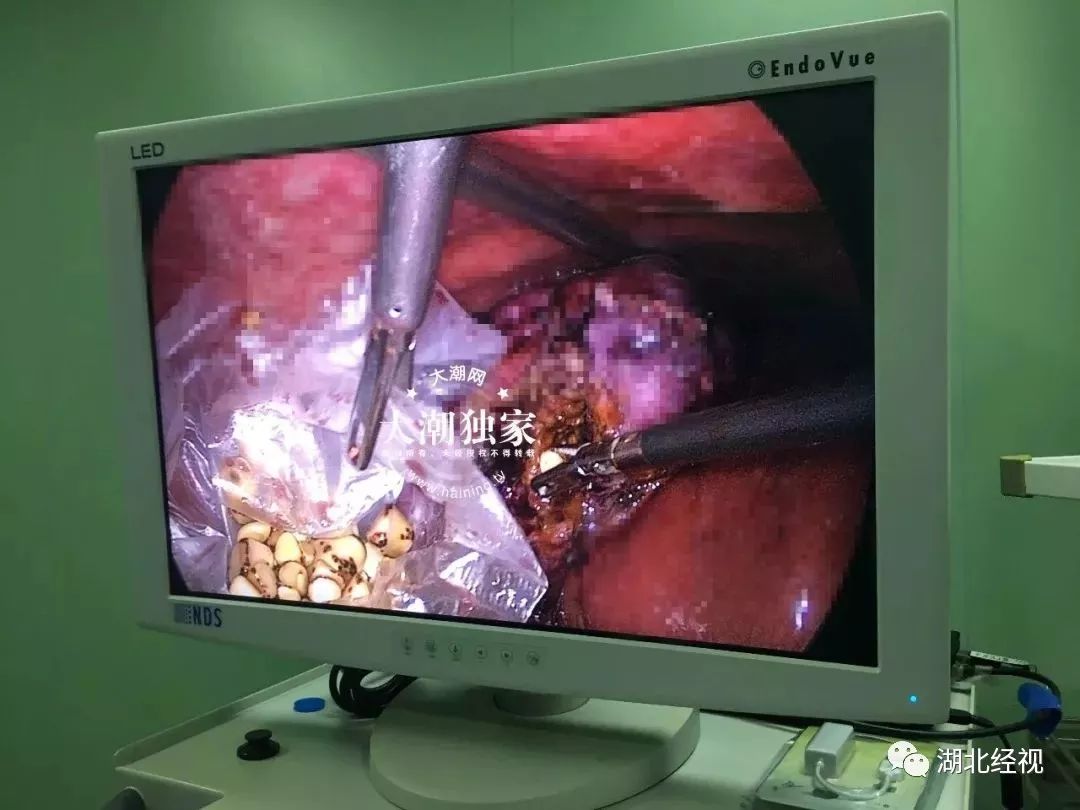 吃过螃蟹后肚子绞痛怎么办,吃螃蟹腹痛用什么解毒