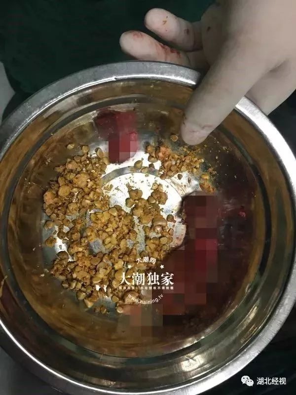 吃过螃蟹后肚子绞痛怎么办,吃螃蟹腹痛用什么解毒