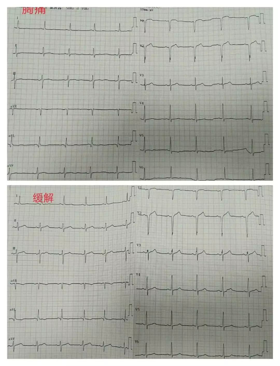 胸痛吃硝酸甘油缓解是怎么回事,发生胸痛为什么慎用硝酸甘油